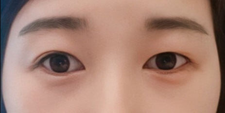눈재수술 후기