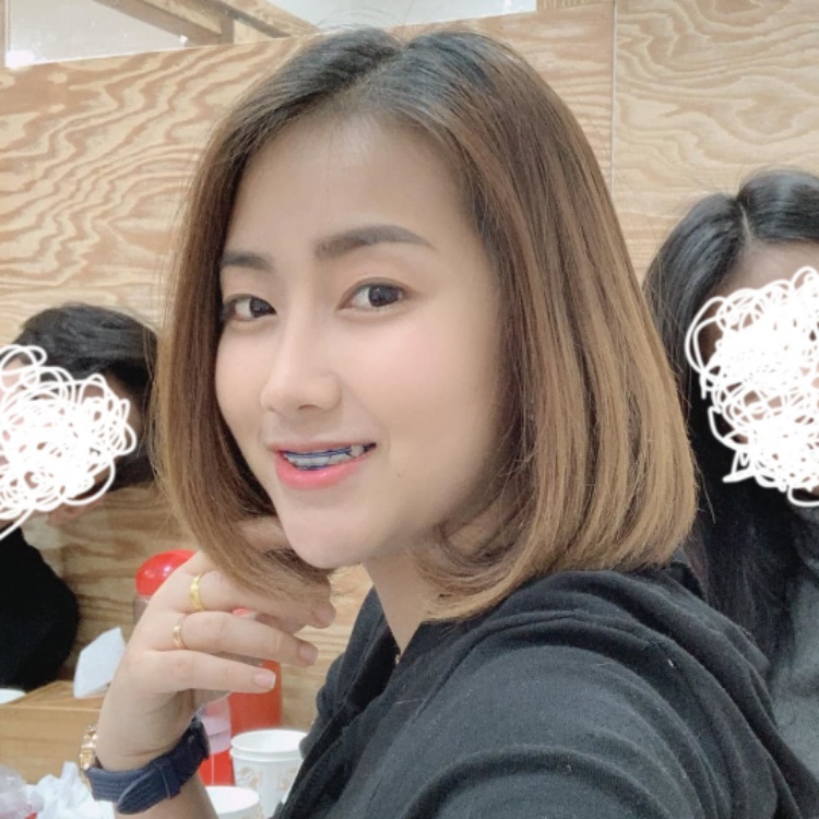쌍꺼풀(매몰) 후기