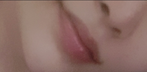 입꼬리성형 후기