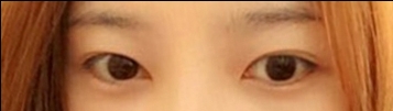 눈재수술 후기