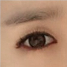 쌍꺼풀(절개) 후기