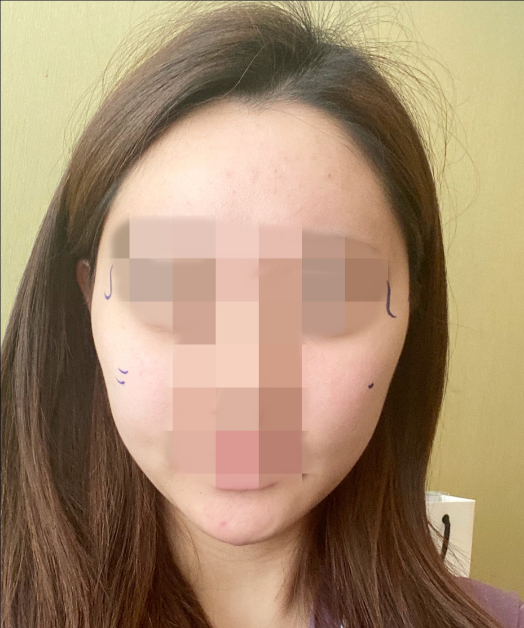광대축소(앞광대) 후기