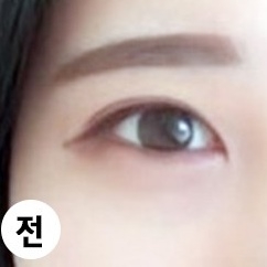 밑트임 후기
