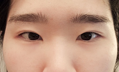 쌍꺼풀(자연유착) 후기
