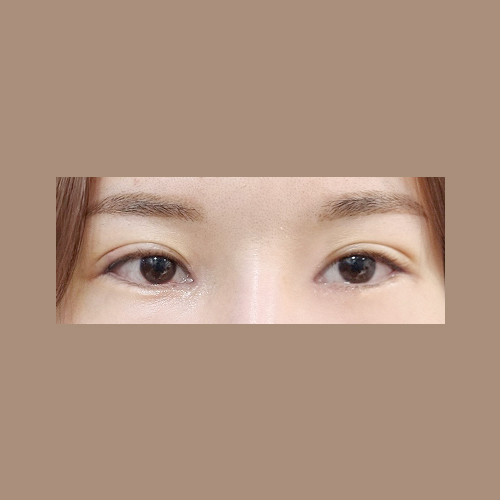 밑트임 후기