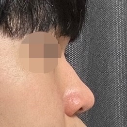 콧볼축소 후기