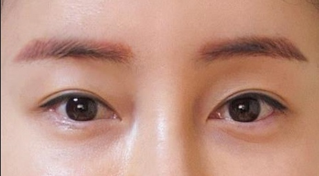 쌍꺼풀(자연유착) 후기
