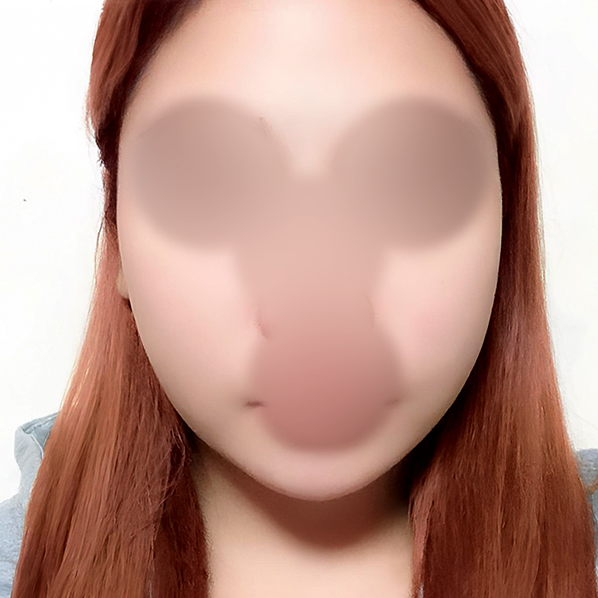 얼굴지방흡입 후기