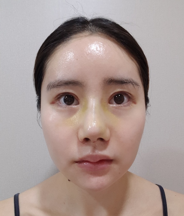 쌍꺼풀(절개) 후기