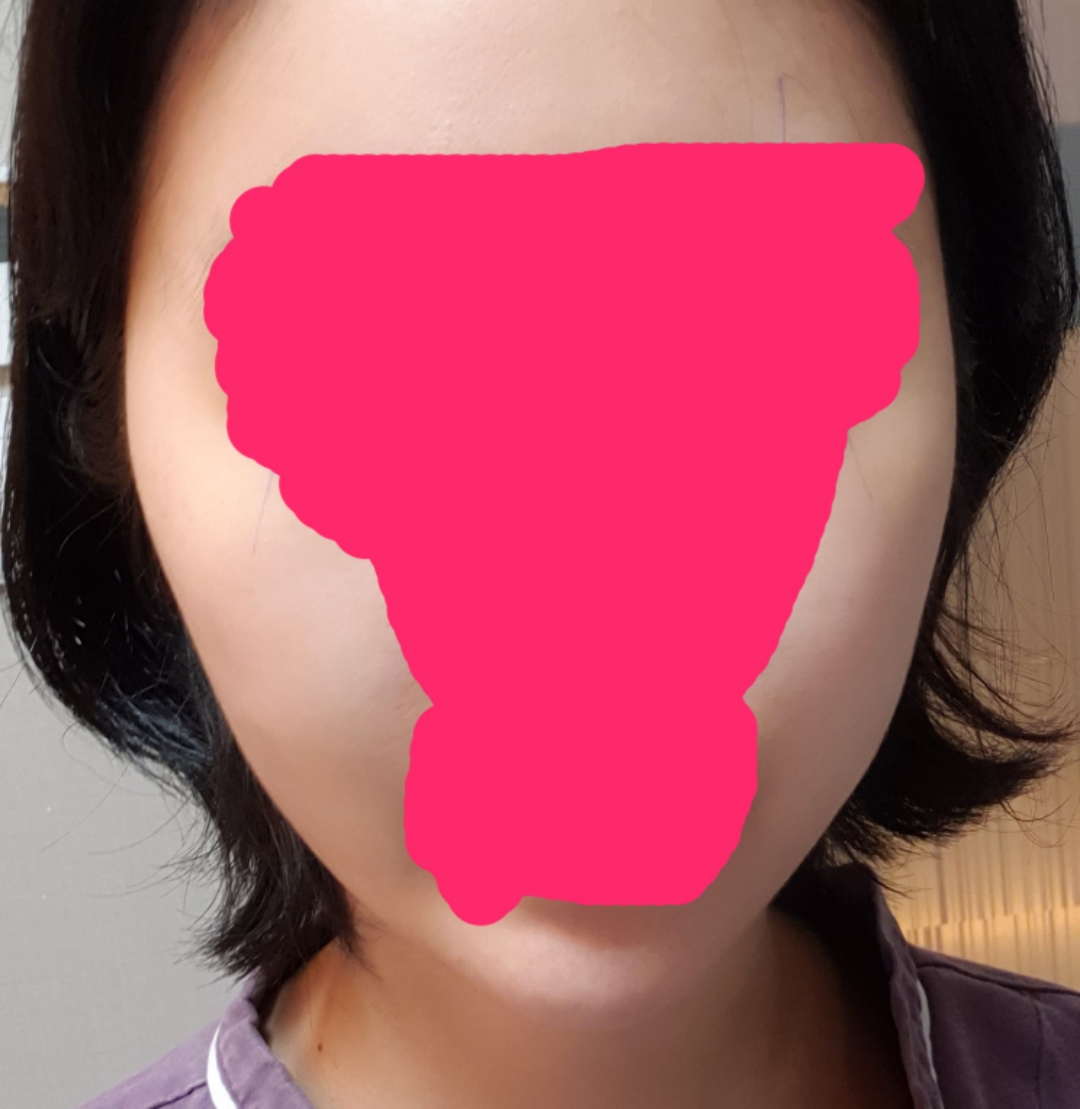 광대축소(앞광대) 후기