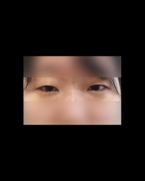 쌍꺼풀(자연유착) 후기