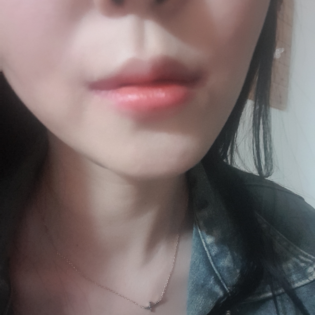 입꼬리성형 후기