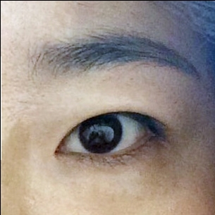 눈재수술 후기
