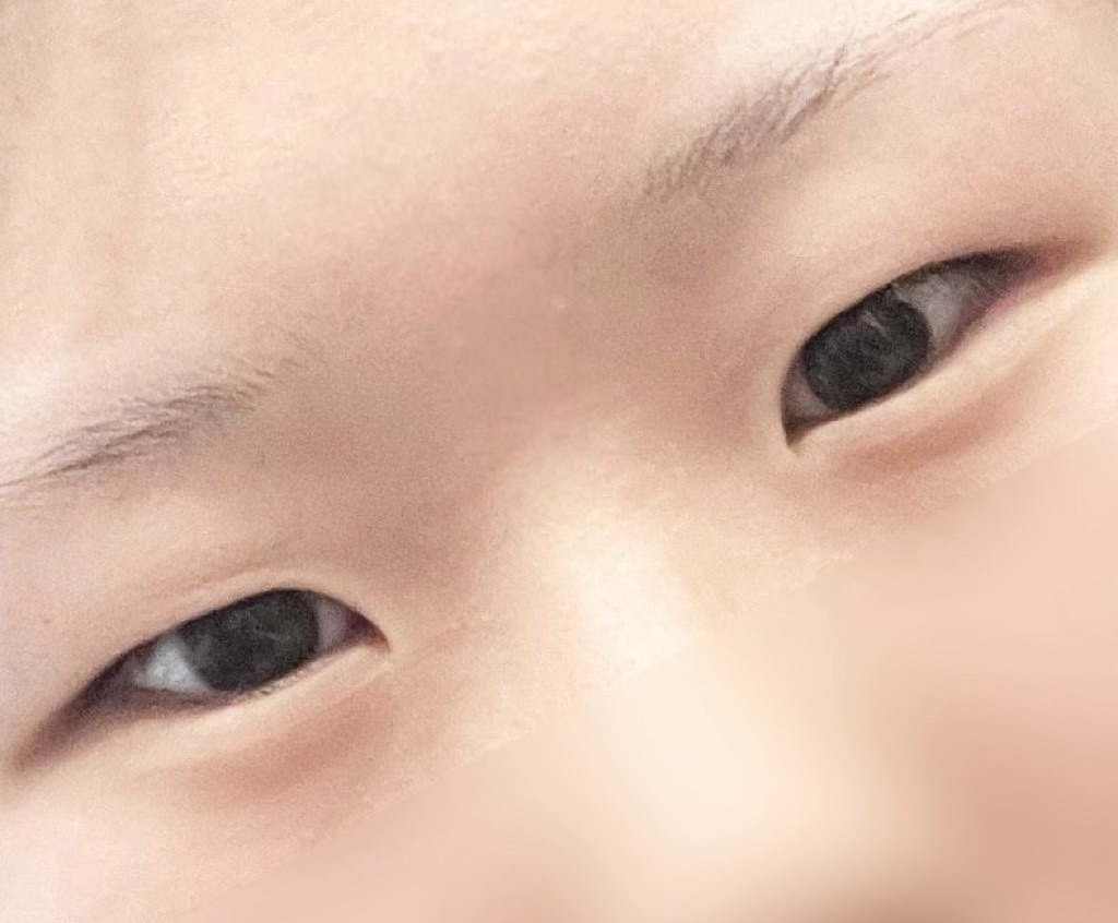 쌍꺼풀(절개) 후기
