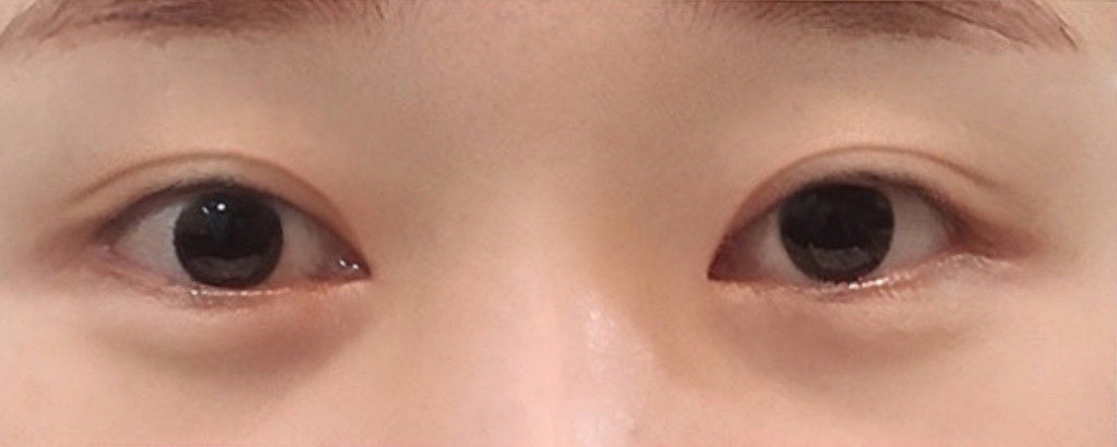 밑트임 후기