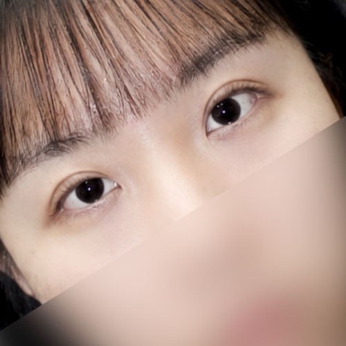 눈재수술 후기