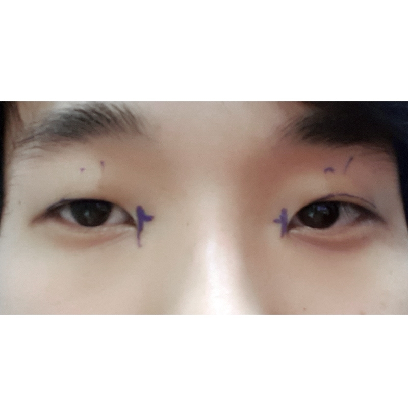 쌍꺼풀(절개) 후기