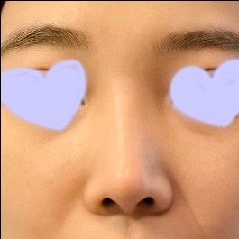 코재수술 후기