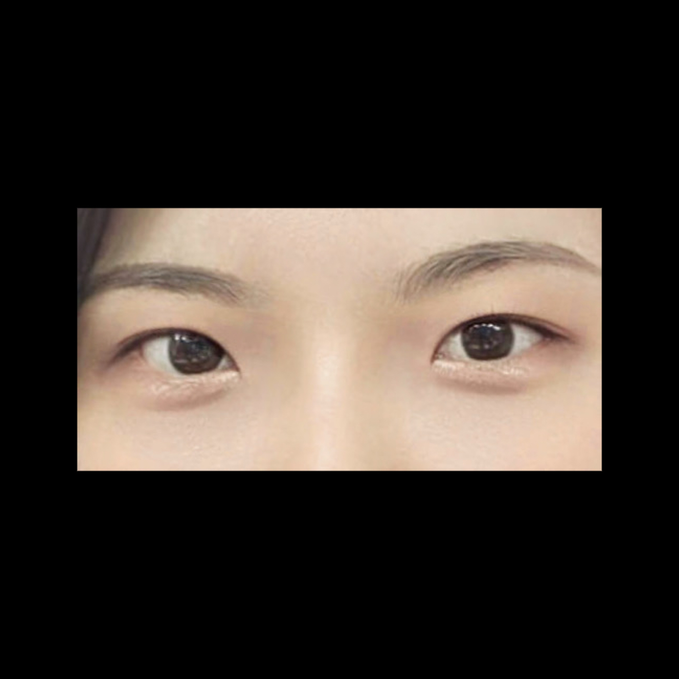밑트임 후기