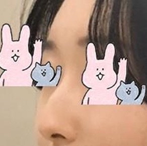 휜코성형 후기