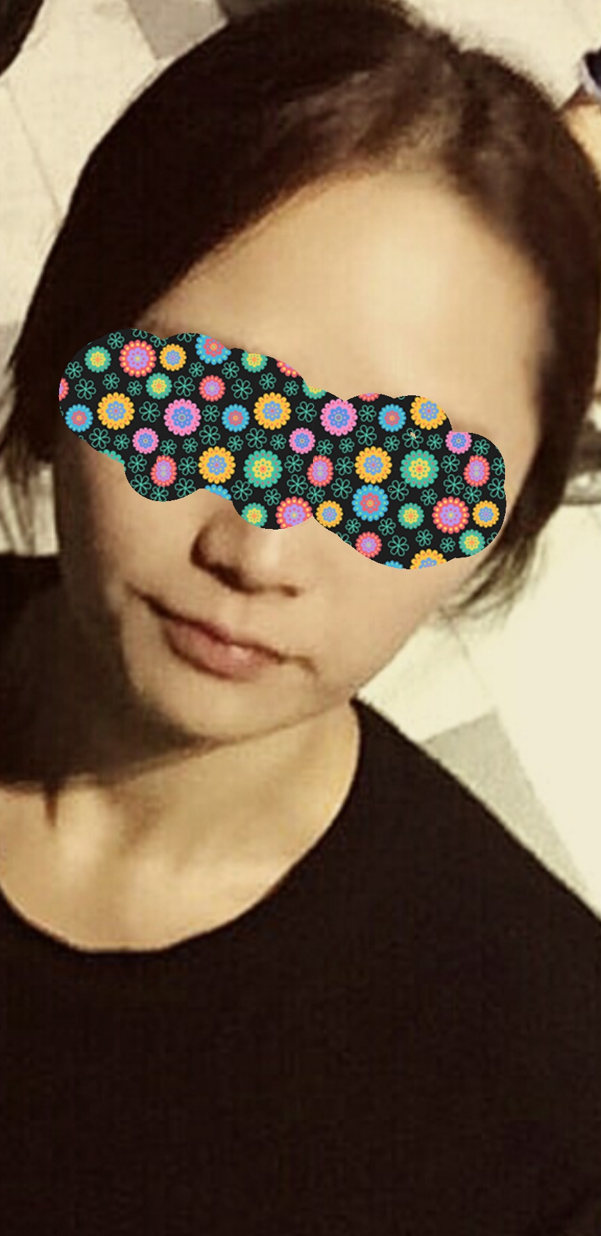 입꼬리성형 후기