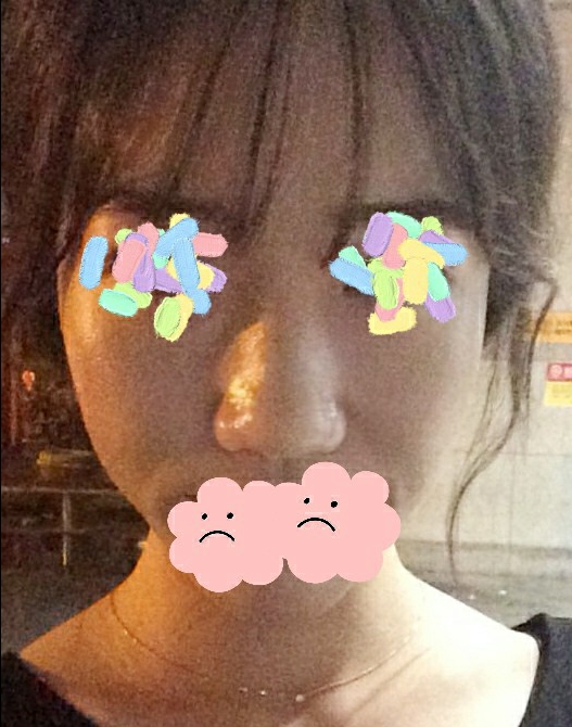 콧대(보형물) 후기
