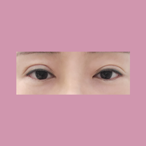 눈재수술 후기