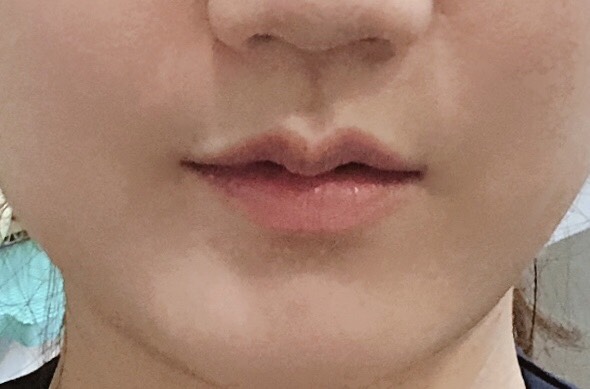 입꼬리성형 후기