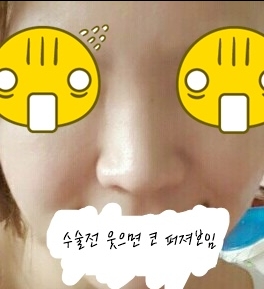 코끝(기증연골) 후기