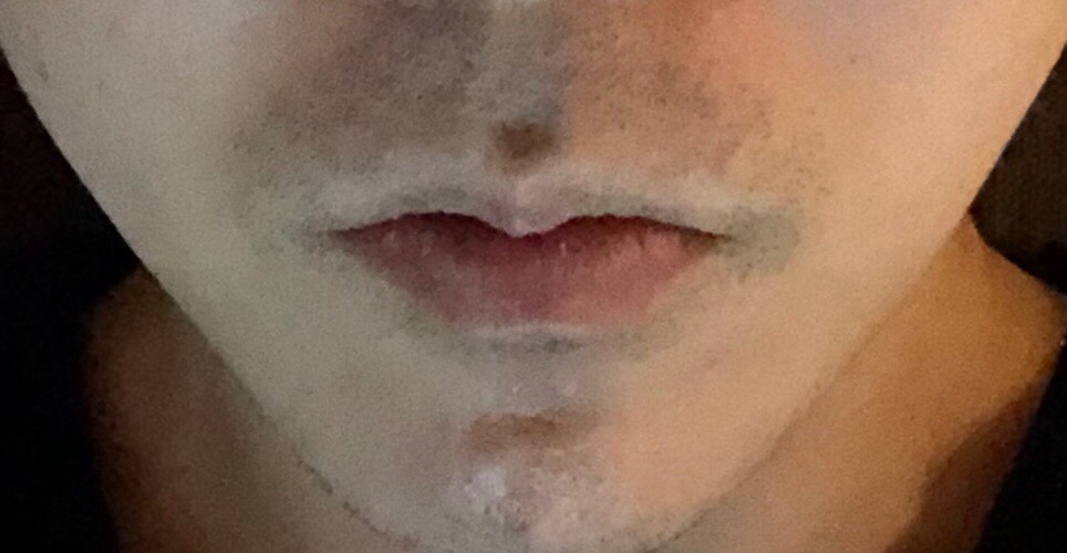 입꼬리성형 후기