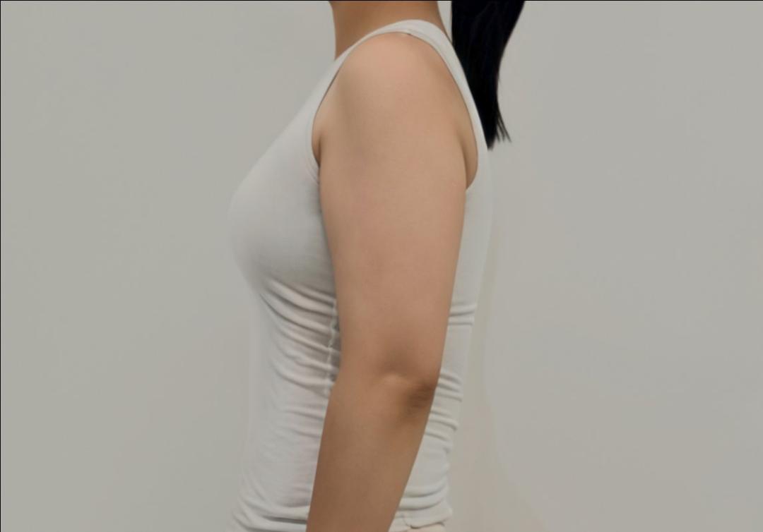 팔지방흡입 후기
