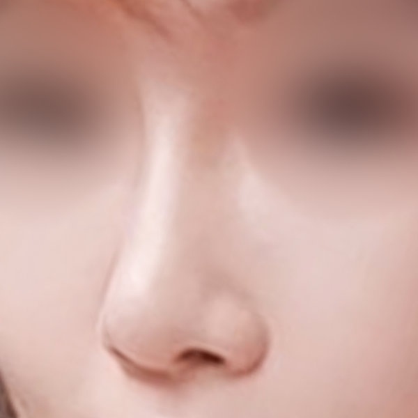콧대(자가조직) 후기