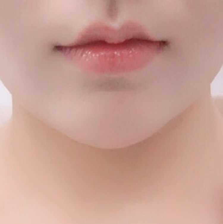 입꼬리성형 후기