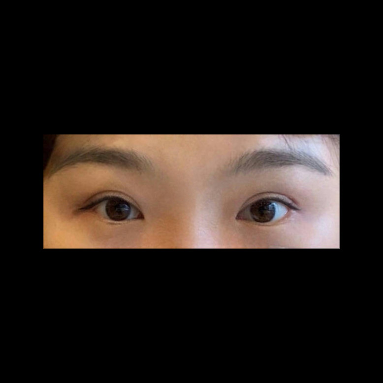 눈재수술 후기