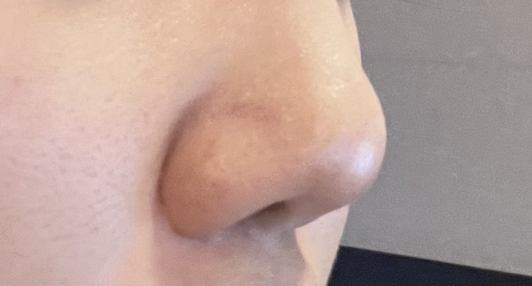 코재수술 후기