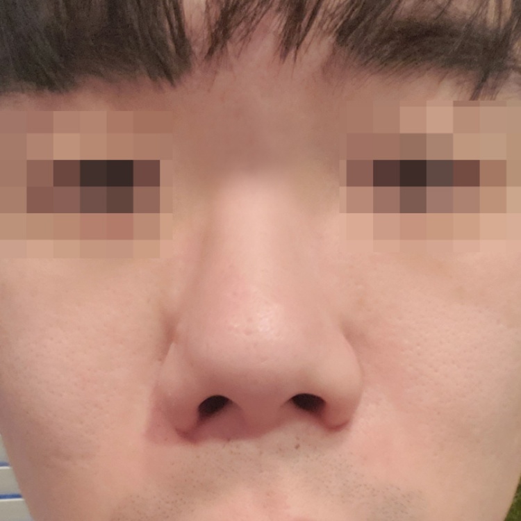 콧볼축소 후기