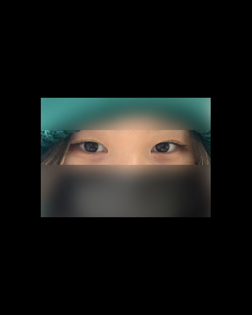눈재수술 후기