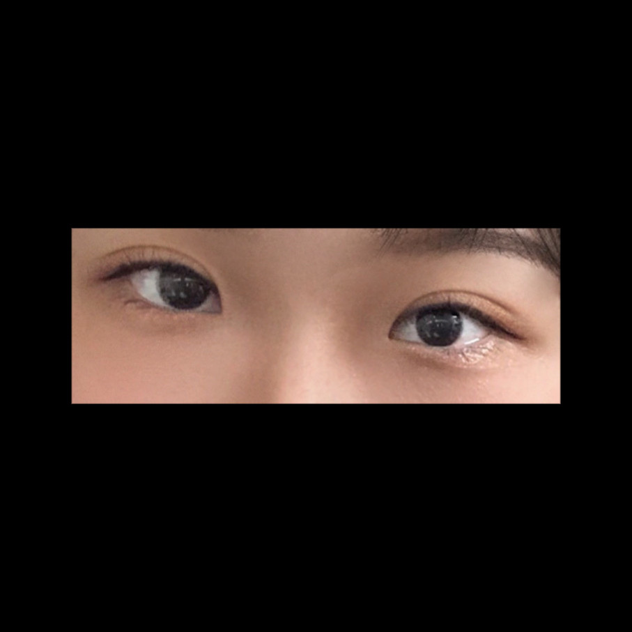 쌍꺼풀(절개) 후기