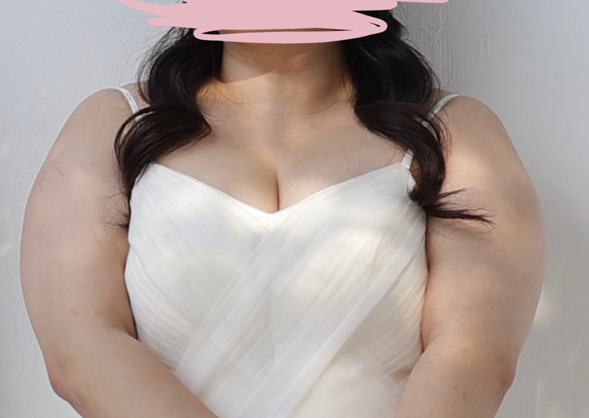 팔지방흡입 후기