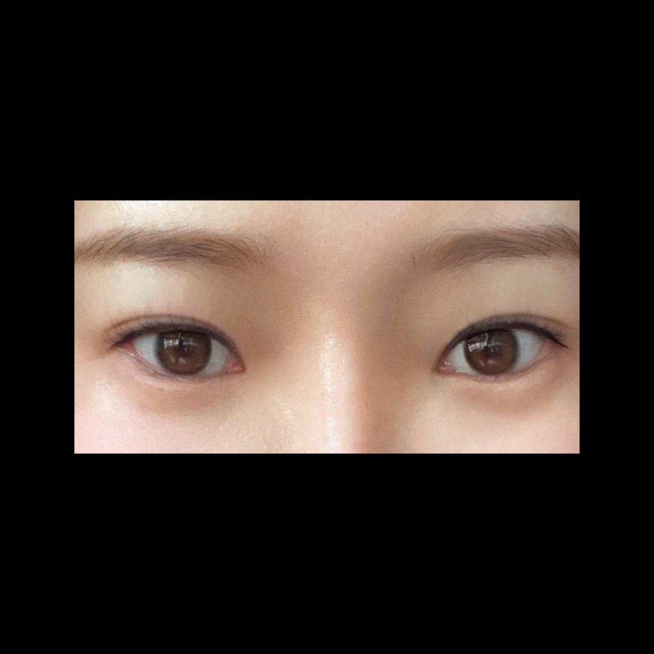 앞트임 후기