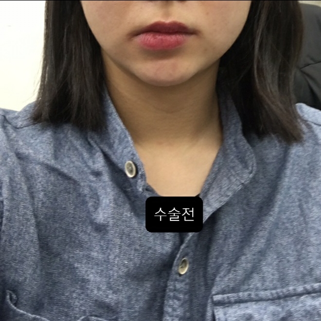 입꼬리성형 후기