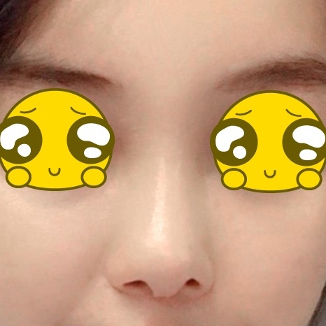 코재수술 후기
