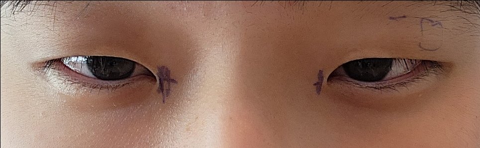 쌍꺼풀(절개) 후기