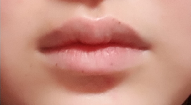 입꼬리성형 후기