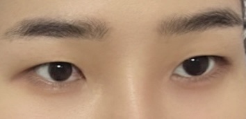 쌍꺼풀(절개) 후기