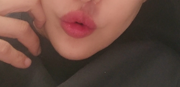 입꼬리성형 후기