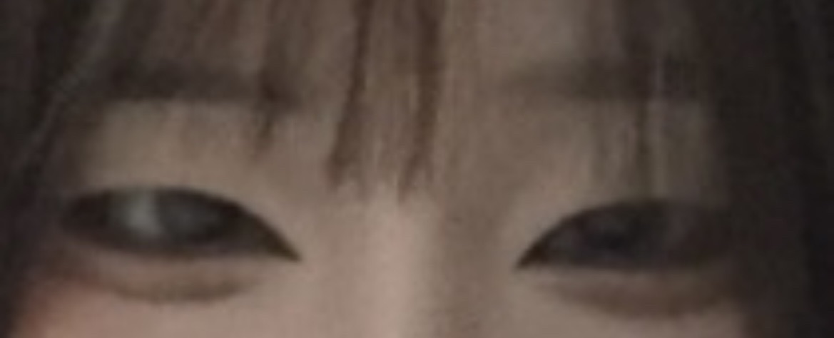 쌍꺼풀(절개) 후기