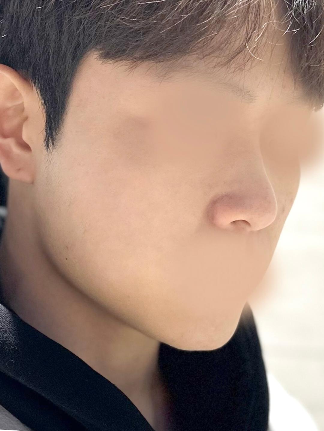 콧대(보형물) 후기