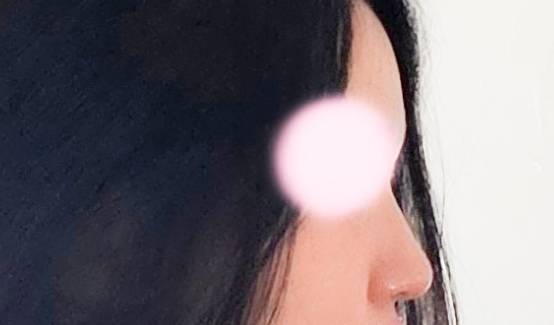 콧대(보형물) 후기