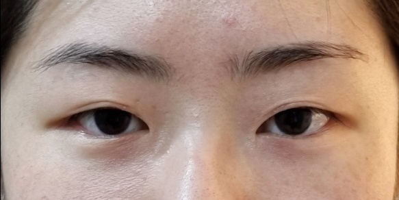 눈재수술 후기